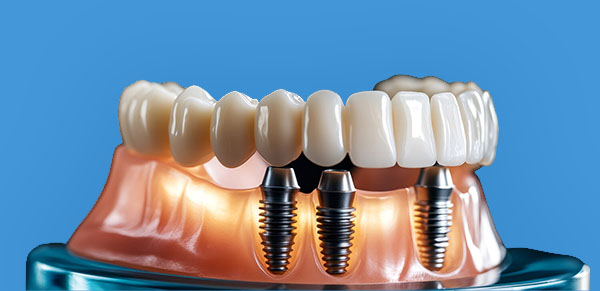Implant-Ustu-Protez- main
