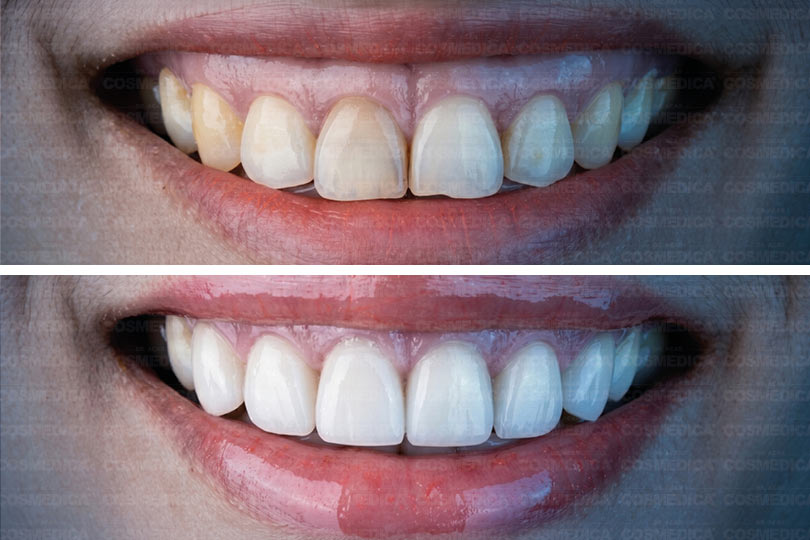 cosmedica-gummy-smile-tedavisi-nasil-yapilir-dis-eti-gorunumu-nasil-duzeltilir-2