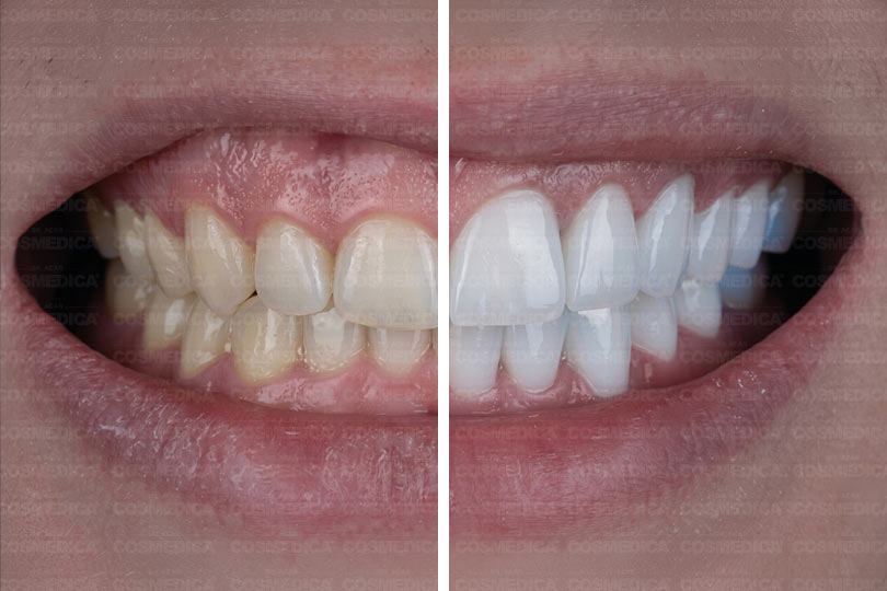 cosmedica-gummy-smile-tedavisi-nasil-yapilir-dis-eti-gorunumu-nasil-duzeltilir-3