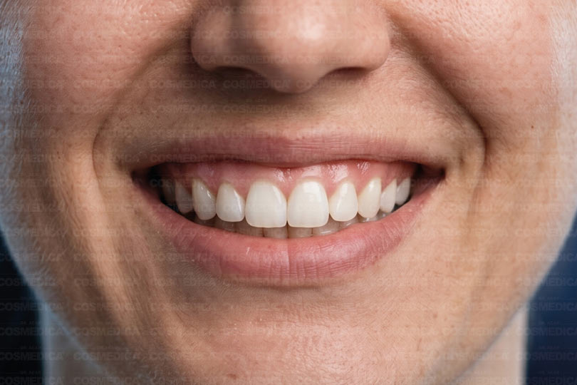 cosmedica-gummy-smile-tedavisi-nasil-yapilir-dis-eti-gorunumu-nasil-duzeltilir