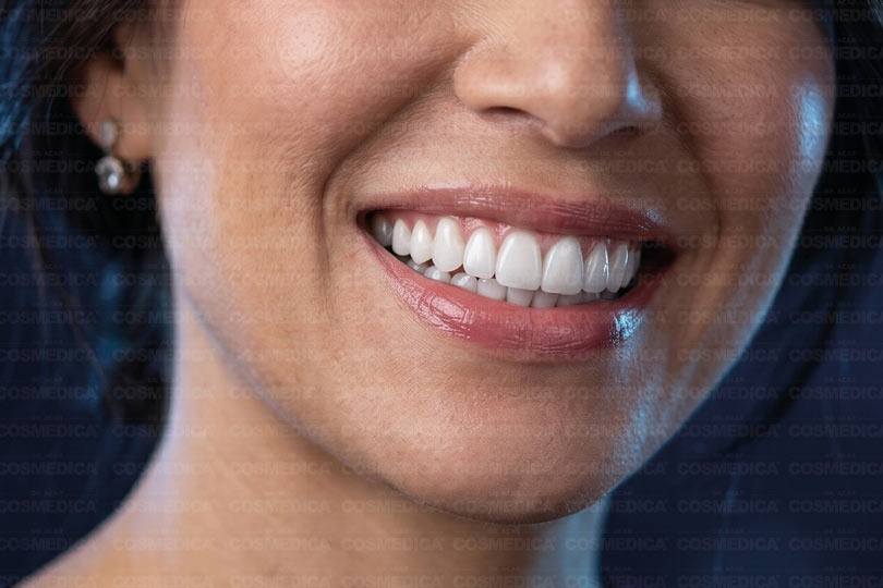 cosmedica-hollywood-smile-nedir-gulus-tasarimi-ile-farklari-ve-uygulama-detaylari
