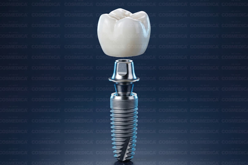 cosmedica-implant-tedavisi-ne-kadar-surer-asamalar-ve-surec-rehberi-2